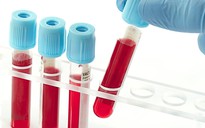 Xét nghiệm máu để biết bệnh nhân ung thư có bị lây lan hay không