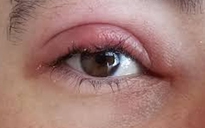 Bác sĩ nhãn khoa chỉ mẹo chữa lẹo mắt hiệu quả
