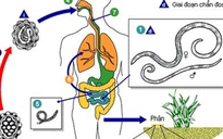 Bé 2 tuổi bị giun đục thủng ruột