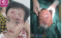 Bé gái 3 tuổi bị nhiều vết thương vùng mặt do bị chó cắn