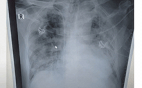 Bệnh nhân 72 tuổi viêm phổi nặng do Covid-19 tử vong