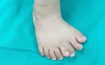 Phẫu thuật chỉnh hình thành công cho bé trai có 9 ngón trên một bàn chân
