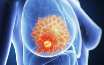 Phụ nữ có mô ngực dày cần cẩn trọng với nguy cơ ung thư vú
