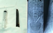 Lấy lưỡi dao Thái Lan dài 12cm bị 'bỏ quên' trong cơ thể 4 năm