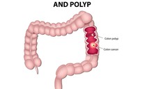 Có cảm giác này khi đi vệ sinh, mau đi khám ung thư ruột