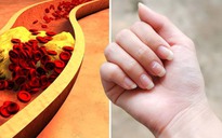 Dấu hiệu trên móng tay tiết lộ mức cholesterol cao nguy hiểm