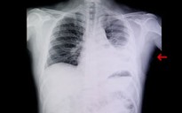 Làm sao để phòng tránh bệnh viêm phổi trong mùa lạnh?