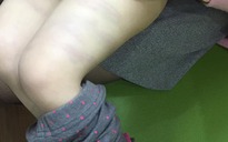 Một trẻ mầm non bị cô giáo đánh thâm tím hai chân