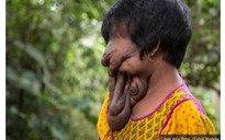 Xót xa cô gái 'không có khuôn mặt' ở Ấn Độ