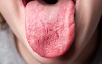 4 dấu hiệu ở lưỡi 'tố cáo' sức khỏe đang có vấn đề