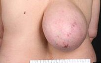 'Địu' khối u to bằng bầu ngực trên lưng