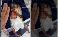 Cặp song sinh nhỏ nhất Ấn Độ được cứu sống thần kì