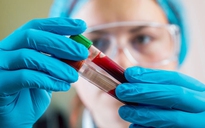 Phát hiện mới: Xét nghiệm máu có thể dự đoán nguy cơ xơ gan
