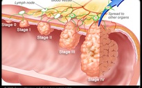 Những dấu hiệu báo động ung thư đại tràng đã di căn