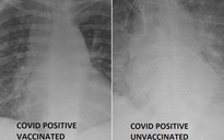 Phim X-quang phổi người đã tiêm vắc xin và chưa tiêm có gì khác khi nhiễm Covid-19?