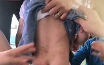 Hà Tĩnh: Bé gái 4 tuổi phải nhập viện, nghi bị bạo hành