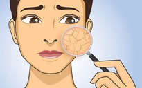 Làn da khô sau khi trị mụn nên sử dụng loại serum nào để dưỡng da?