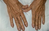 7 dấu hiệu trên móng tay cảnh báo bệnh tật của bạn