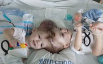 Ca phẫu thuật nghẹt thở tách thành công đôi song sinh 13 tháng tuổi dính đầu