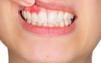 8 dấu hiệu bệnh răng miệng 'tố cáo' sức khỏe bạn đang có vấn đề