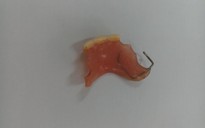 Gắp hàm răng giả có móc kim loại ra khỏi thực quản bệnh nhân