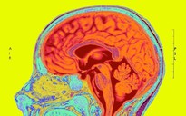 Nghiên cứu: Covid-19 có thể gây 'teo não'