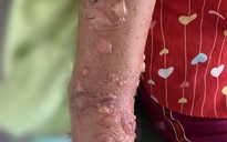 Bị sứa 'cắn' gây bỏng da, phải nhập viện trị cả tuần