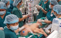 Gần 100 y, bác sĩ đang phẫu thuật tách cặp song sinh dính nhau vùng bụng chậu