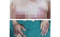 Hai phụ nữ nhập viện cắt bỏ phần ngực bị hoại tử do làm đẹp ở cơ sở 'dỏm'