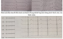 Cứu sống bệnh nhân 'tim đập 300 lần/phút'