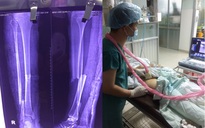 Bệnh viện quận ghép xương thành công cho bệnh nhân bệnh tim phức tạp