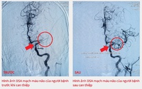 Chụp mạch máu não cứu bệnh nhân đột quỵ