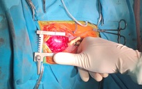 Phẫu thuật 'sửa lỗi' cho trái tim nhỏ bằng ngón tay cái của em bé sinh non