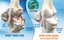 Phát hiện mới giúp điều trị thoái hóa khớp trúng đích