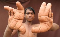 Những người mắc bệnh lạ: Cậu bé bị coi là 'quỷ' vì có ngón tay khổng lồ