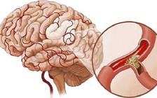 71% người bệnh bị mất khả năng lao động sau đột quỵ