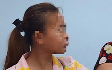 Bé gái chạy xe máy bị tai nạn giao thông biến dạng vùng mặt