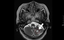 Cụ bà vừa xuống máy bay thì bị sốc nhiệt, loạn thần, được cấp cứu kịp thời