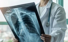 AI có thể sàng lọc ung thư phổi hiệu quả