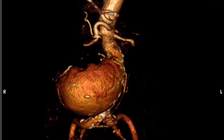 Cứu sống cụ ông 93 tuổi bị phình động mạch chủ bụng 12 cm