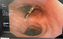 Người phụ nữ mắc xương cá ở phổi mà không biết, tưởng là hen suyễn