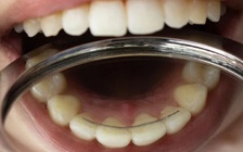 Răng cắm sâu vào chân mày do va chạm, 6 ngày sau mới phát hiện