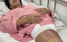 Bệnh viện Chợ Rẫy kỳ tích 112 ngày cứu người bị xe container cán nguy cơ chết đến 90%