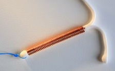 Không có con do vòng tránh thai nằm trong tử cung suốt 29 năm mà không biết