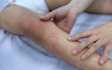 Sốt xuất huyết tại TP.HCM gia tăng