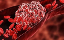 Thức dậy bị đau chân, cô gái ở Anh tử vong vì 'kẻ giết người thầm lặng'