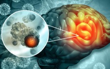 Mỗi lần nói chuyện là nhức mặt, cô gái đi khám phát hiện u não