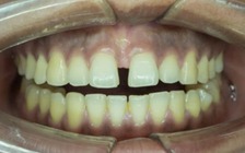 Nướu chuyển sang màu đen có nguy hiểm không?