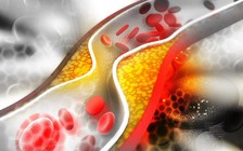 Ngày mới với tin tức sức khỏe: Dấu hiệu cảnh báo cholesterol cao