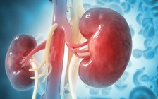 Lấy thành công 153 viên sỏi từ thận bệnh nhân